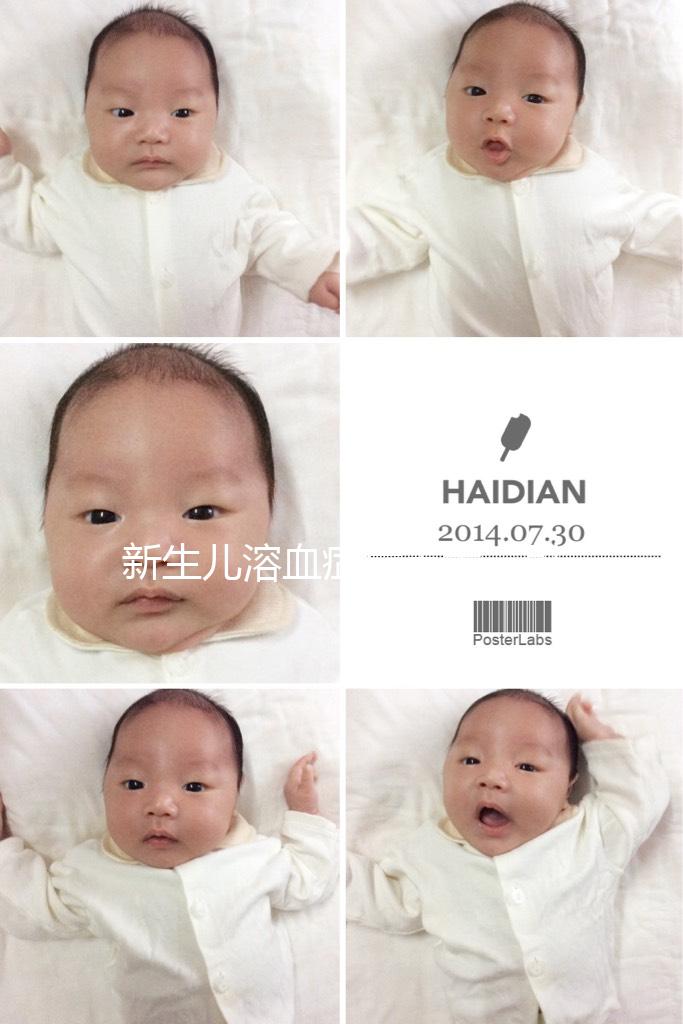 新生兒溶血癥危害大，引發膽紅素腦病可致神經后遺癥